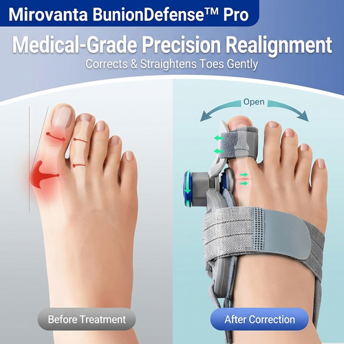BunionDefense™ Pro: Adjustable Orthopedic Splint (With Knob-Technology)